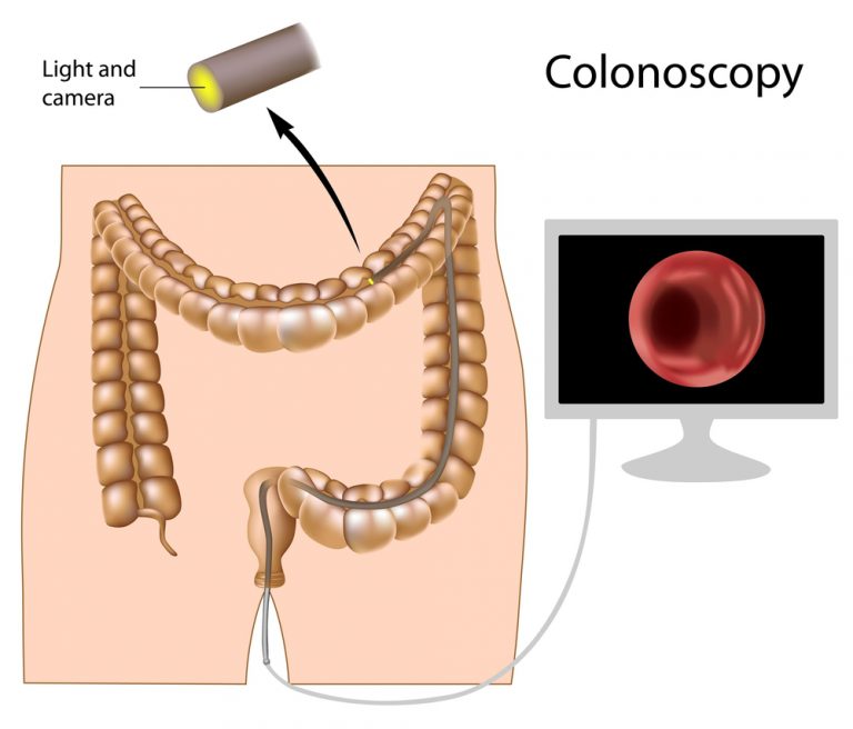 Colonoscopy Specialist Chicago West Loop Colon Cancer Screening Evanston Oak Park IL