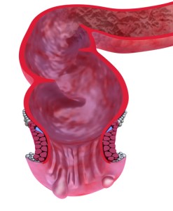 Anoscopy illustration