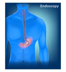 Esophagogastroduodenoscopy (EGD) illustration